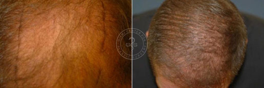 patient-3412-hair-transplant-before-after