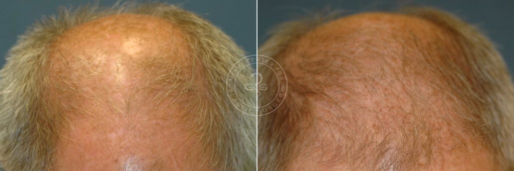 patient-3412-hair-transplant-before-after