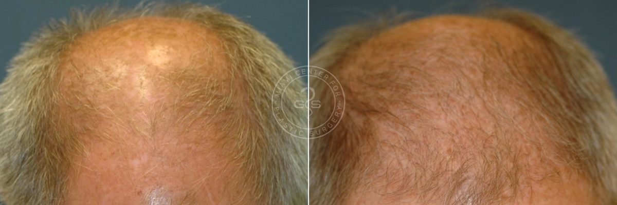 Hair Transplant before and after photos in Miami Beach, FL, Patient 3422