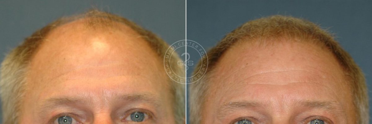 Hair Transplant before and after photos in Miami Beach, FL, Patient 3422