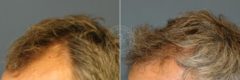 Hair Transplant before and after photos in Miami Beach, FL, Patient 3429