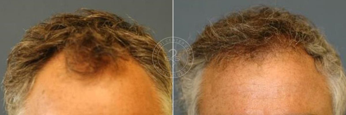 Hair Transplant before and after photos in Miami Beach, FL, Patient 3429