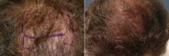 Hair Transplant before and after photos in Miami Beach, FL, Patient 3436