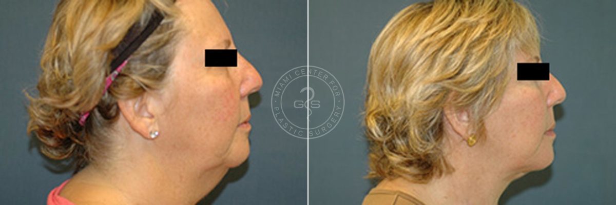 Face and Neck Lift before and after photos in Miami Beach, FL, Patient 3467