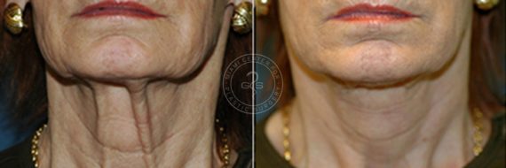 Face and Neck Lift before and after photos in Miami Beach, FL, Patient 3477