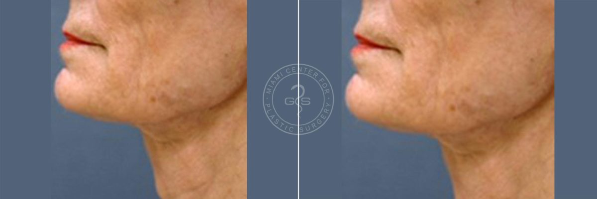 Face and Neck Lift before and after photos in Miami Beach, FL, Patient 3477