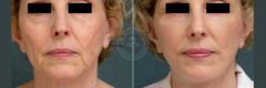 Face and Neck Lift before and after photos in Miami Beach, FL, Patient 3487