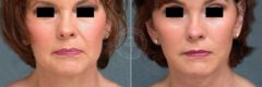 Face and Neck Lift before and after photos in Miami Beach, FL, Patient 3491