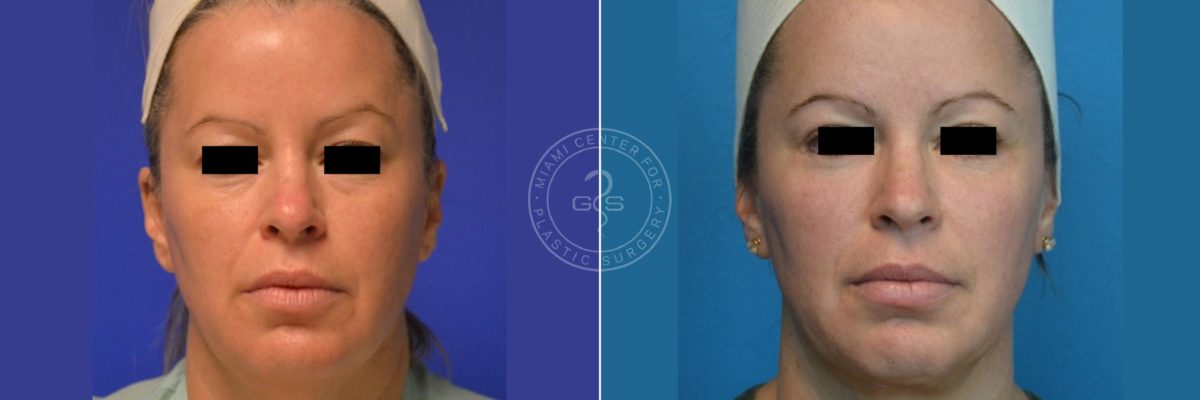 Face and Neck Lift before and after photos in Miami Beach, FL, Patient 3495
