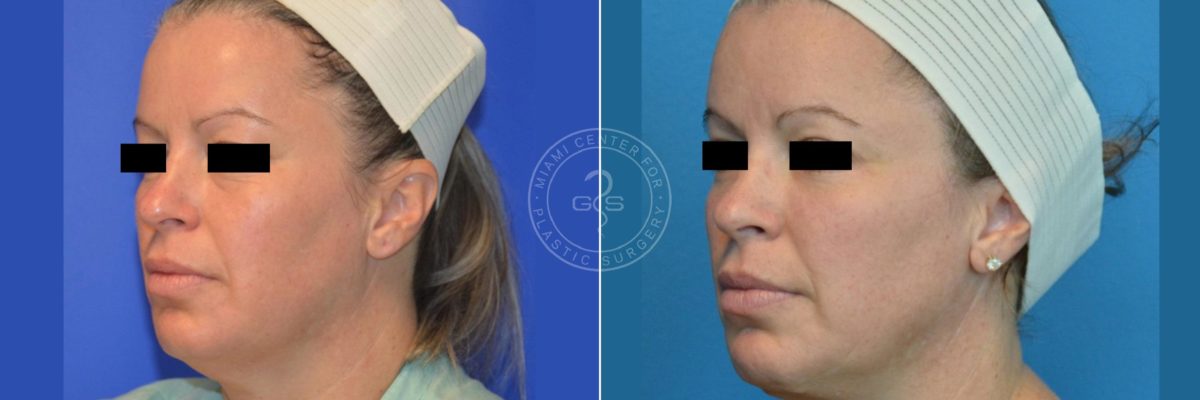 Face and Neck Lift before and after photos in Miami Beach, FL, Patient 3495
