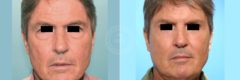 Face and Neck Lift before and after photos in Miami Beach, FL, Patient 3515