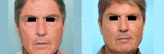 Face and Neck Lift before and after photos in Miami Beach, FL, Patient 3515