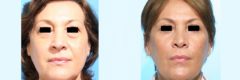 Face and Neck Lift before and after photos in Miami Beach, FL, Patient 3522