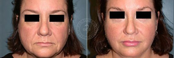 Face and Neck Lift before and after photos in Miami Beach, FL, Patient 3440
