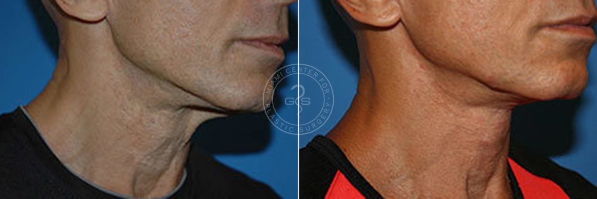 Face and Neck Lift before and after photos in Miami Beach, FL, Patient 3457