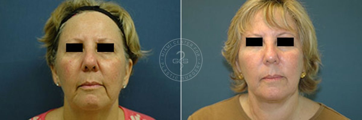 Face and Neck Lift before and after photos in Miami Beach, FL, Patient 3467