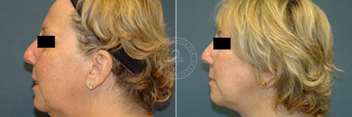 Face and Neck Lift before and after photos in Miami Beach, FL, Patient 3467