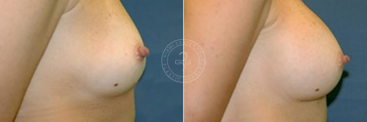 Breast Augmentation before and after photos in Miami Beach, FL, Patient 3723