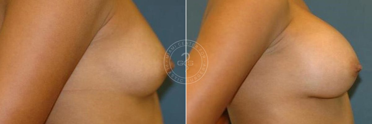 Breast Augmentation before and after photos in Miami Beach, FL, Patient 3731