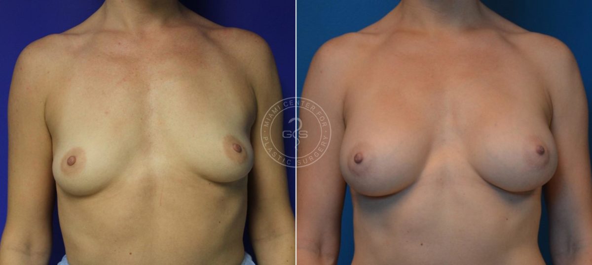 Breast Augmentation before and after photos in Miami Beach, FL, Patient 4644