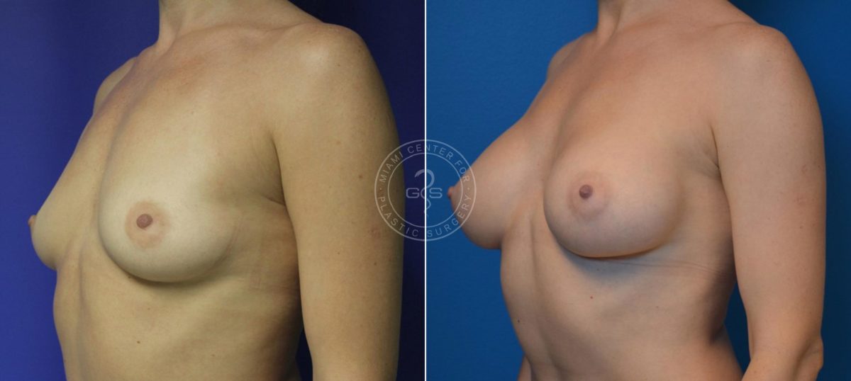 Breast Augmentation before and after photos in Miami Beach, FL, Patient 4644