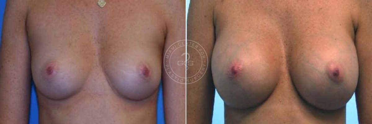 Breast Augmentation before and after photos in Miami Beach, FL, Patient 3738