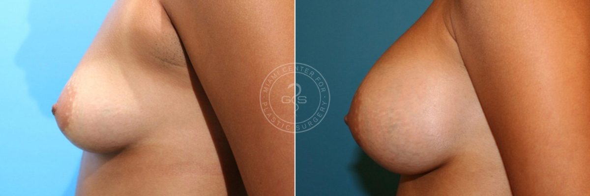 Breast Augmentation before and after photos in Miami Beach, FL, Patient 3738