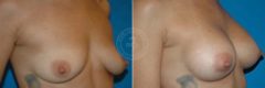 Breast Augmentation before and after photos in Miami Beach, FL, Patient 4542