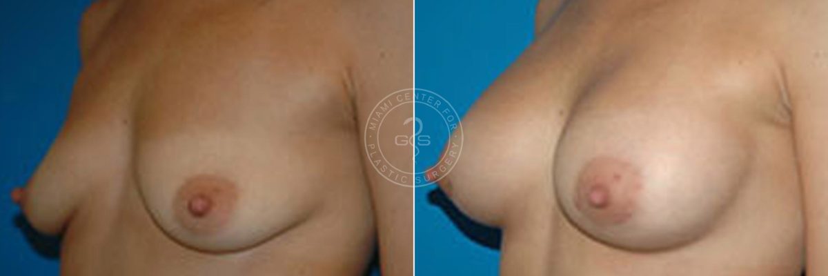Breast Augmentation before and after photos in Miami Beach, FL, Patient 4542