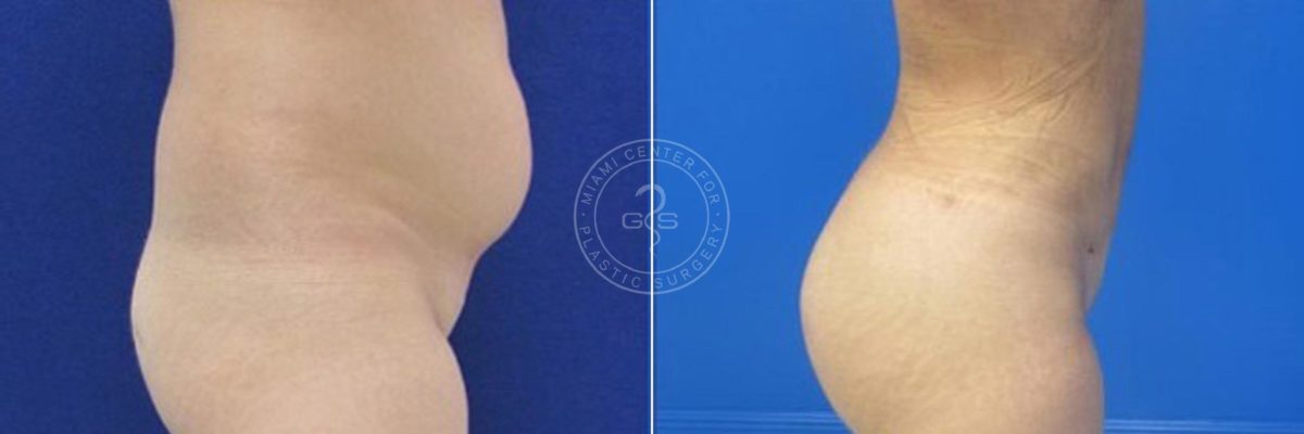 Fat Transfer before and after photos in Miami Beach, FL, Patient 3809