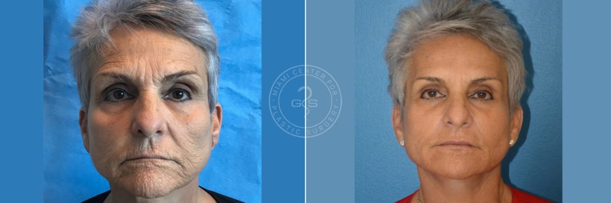 Fillers & Injectables before and after photos in Miami Beach, FL, Patient 4670
