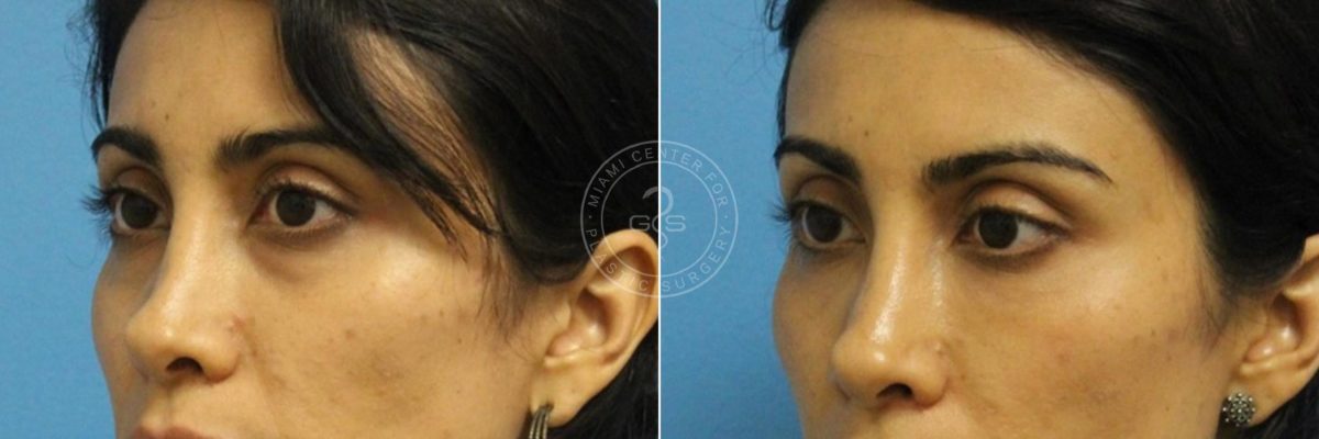 Fillers & Injectables before and after photos in Miami Beach, FL, Patient 4659