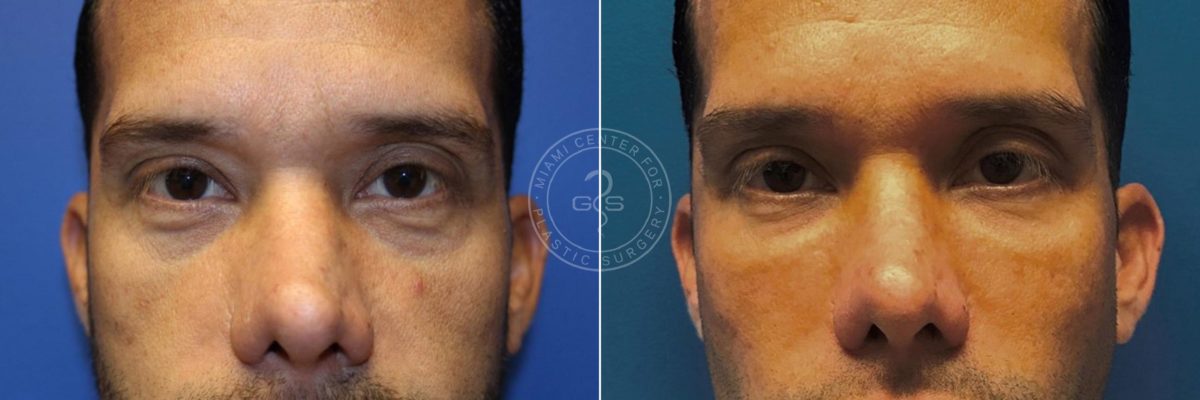 Fillers & Injectables before and after photos in Miami Beach, FL, Patient 4666