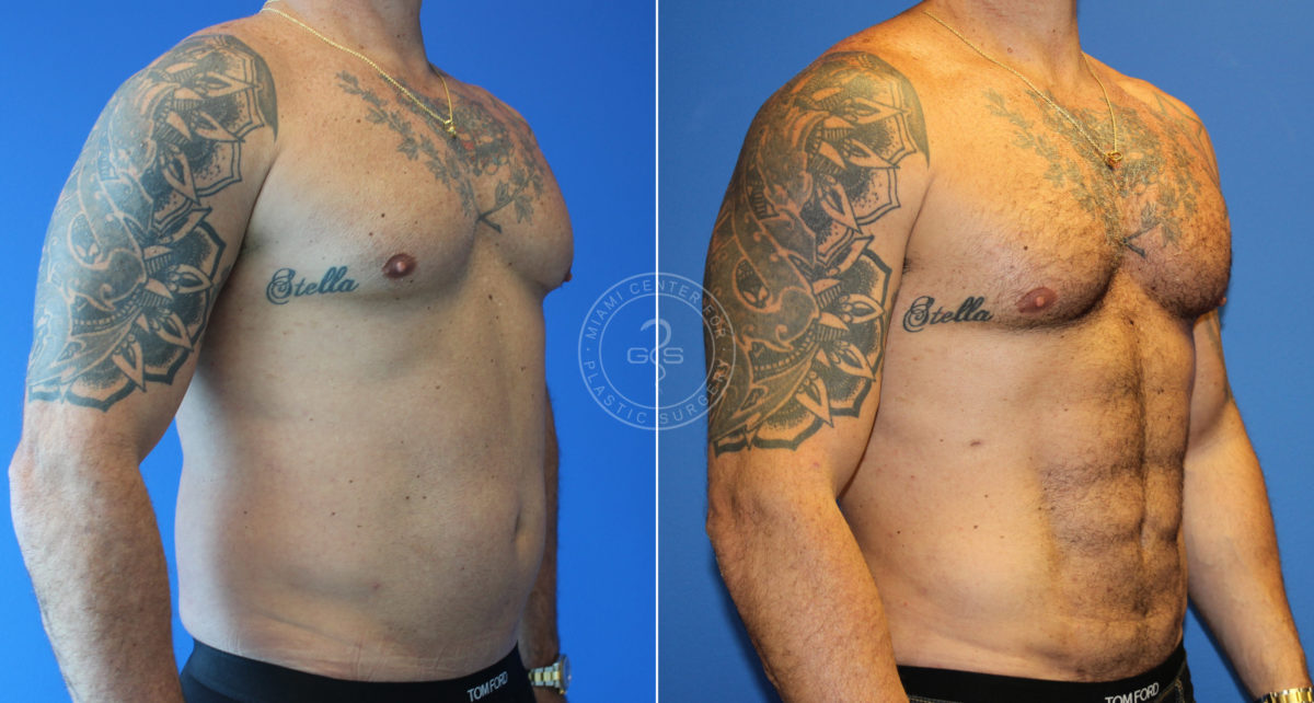 Liposculpting - Abdominal Etching before and after photos in Miami Beach, FL, Patient 5489