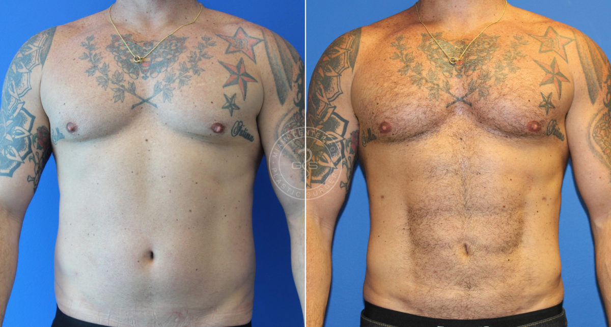 Liposculpting - Abdominal Etching before and after photos in Miami Beach, FL, Patient 5489