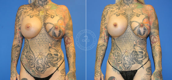Fat Transfer before and after photos in Miami Beach, FL, Patient 5508