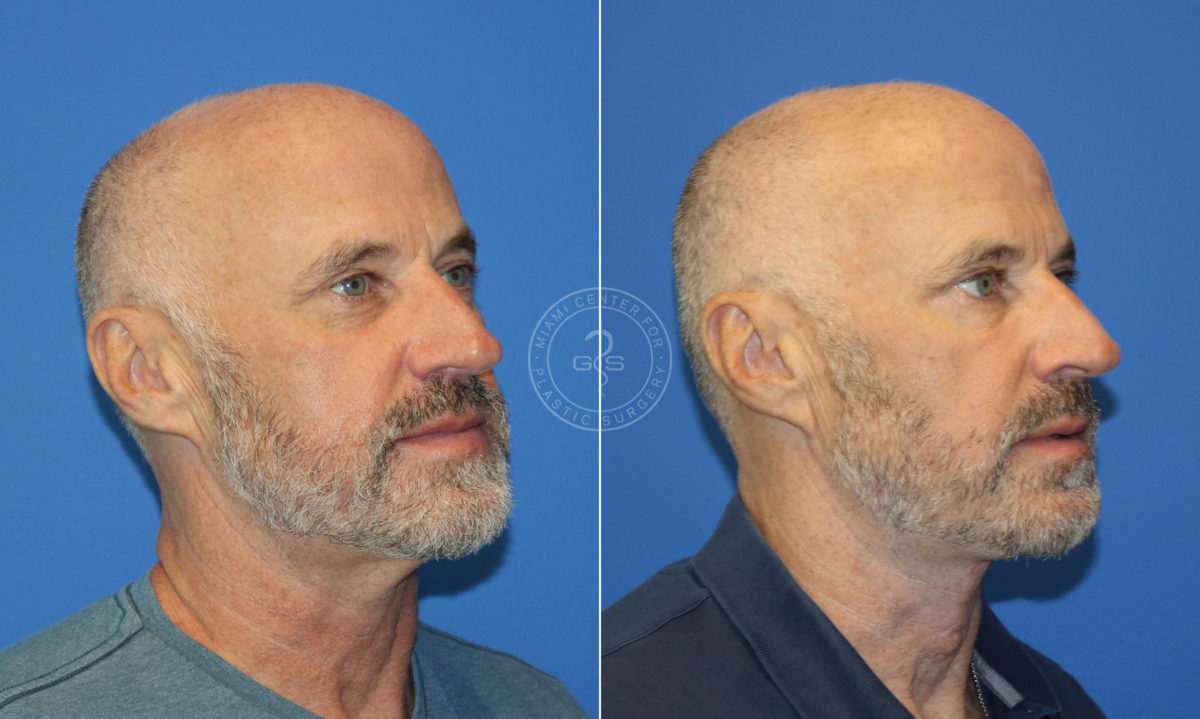 Blepharoplasty before and after photos in Miami Beach, FL, Patient 5527