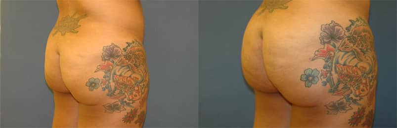 Results from a Brazilian Butt Lift surgery 1