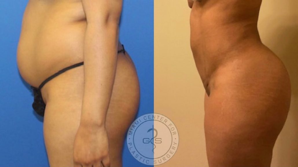 Results from a Brazilian Butt Lift surgery 2