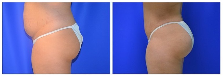 Results from a Brazilian Butt Lift surgery 4