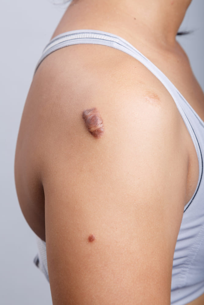 Ask for ways to permanently remove a keloid scar