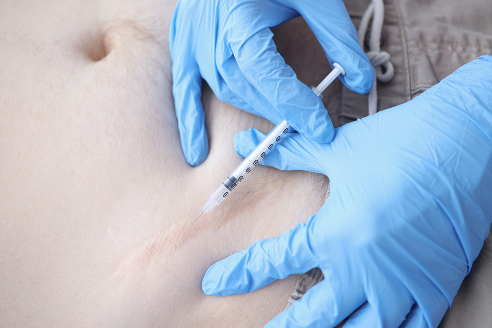 Liposuction and Keloids: How to Manage and Treat Scarring