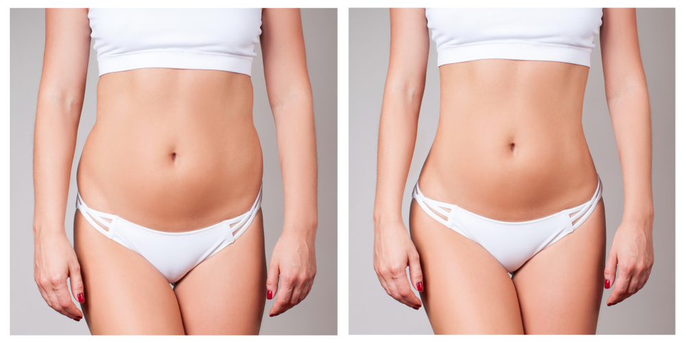 The First Weeks After Liposuction: What to Expect and How to Heal