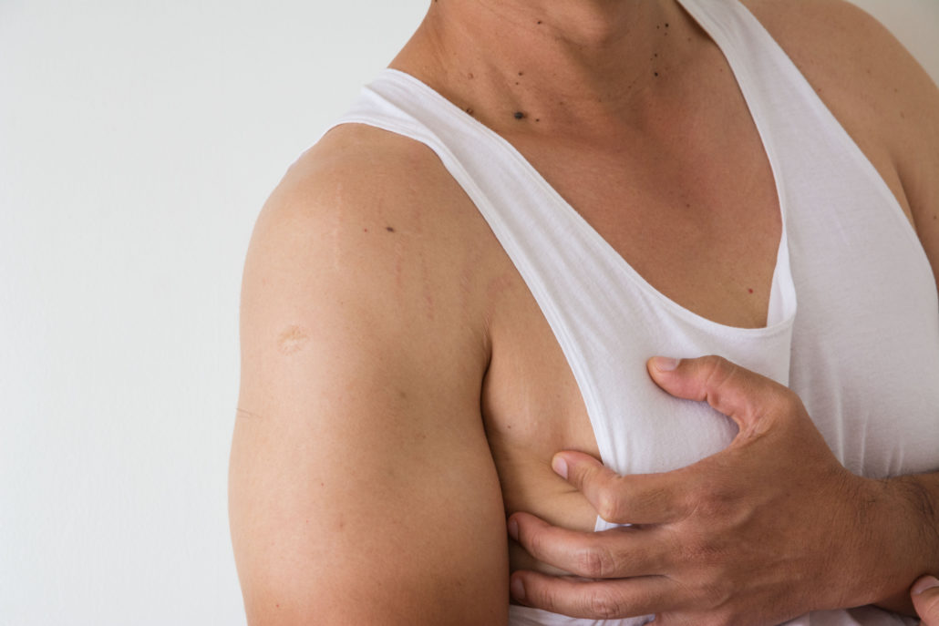 Recovering from Gynecomastia surgery