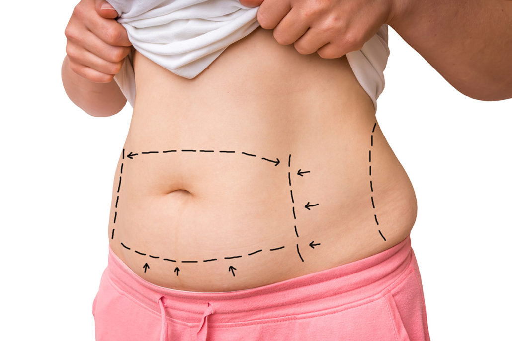 incision lines for an abdominoplasty procedure