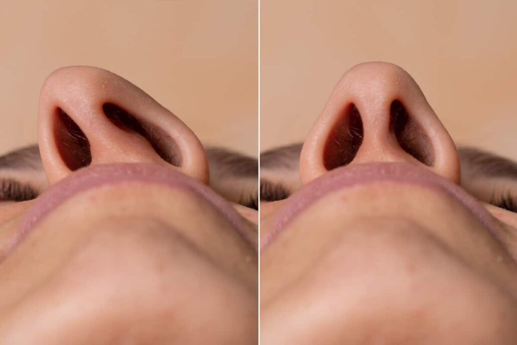 Before and after a deviated septum surgical treatment.