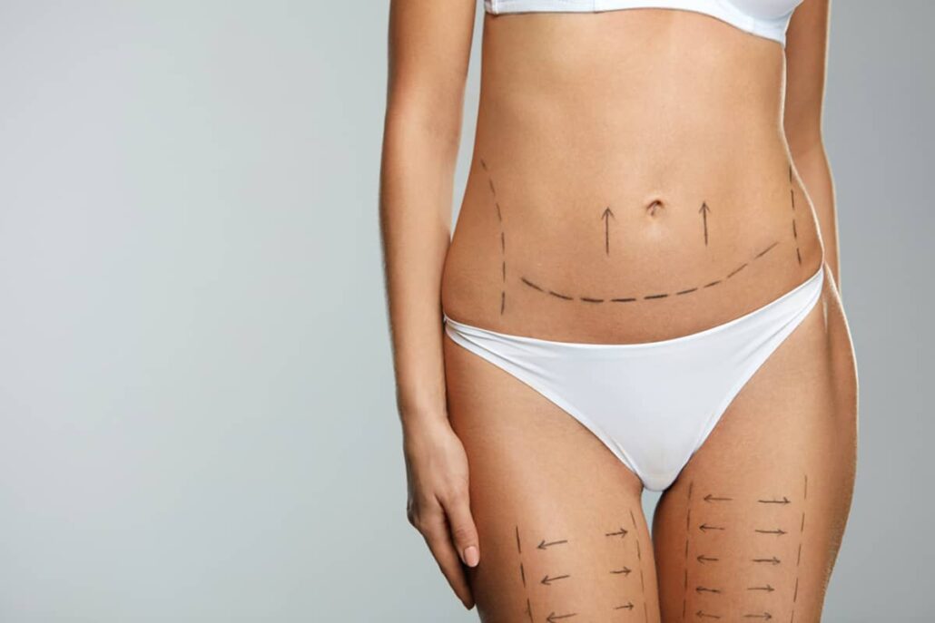 During a lower body lift procedure, the surgeon may use liposuction to remove additional fat and also perform buttock implants or fat grafting to enhance the shape and size of the buttocks.