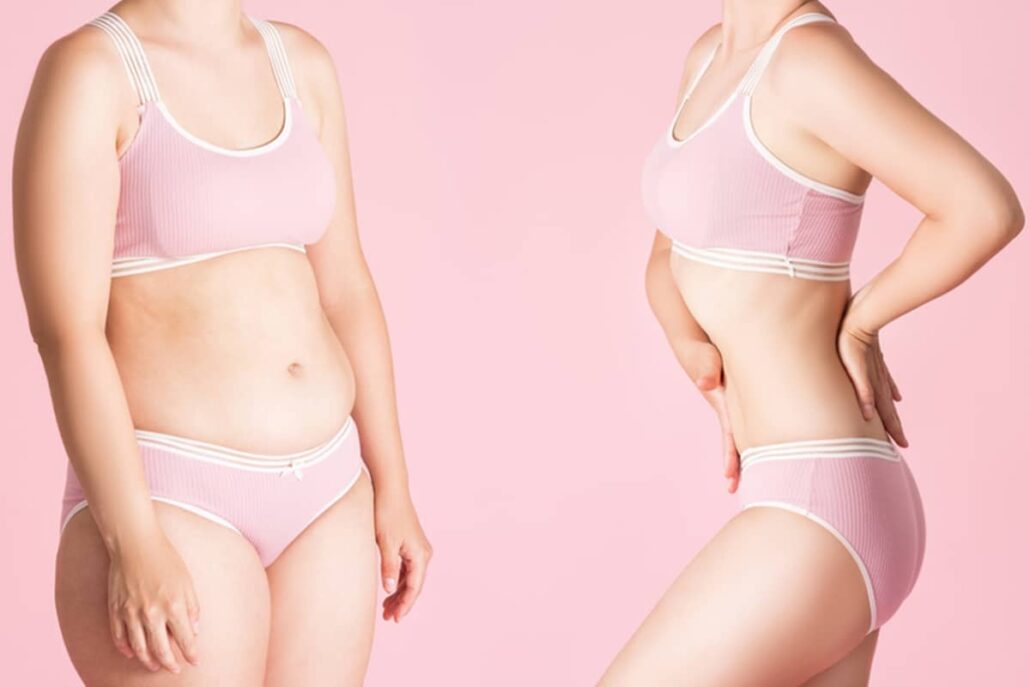 Abdominoplasty removes excess skin and tightens abdominal muscles
