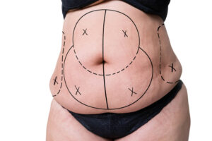 The recovery time for tummy tuck surgery can vary depending on the individual and the type of procedure performed, but typically lasts around four weeks