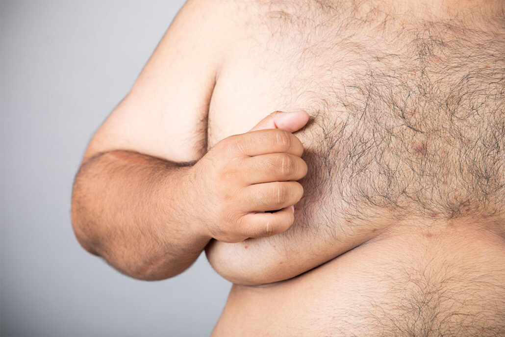 Gynecomastia is the enlargement of male breast tissue, often caused by an imbalance of hormones, while pseudogynecomastia refers to the accumulation of fat in the chest area.